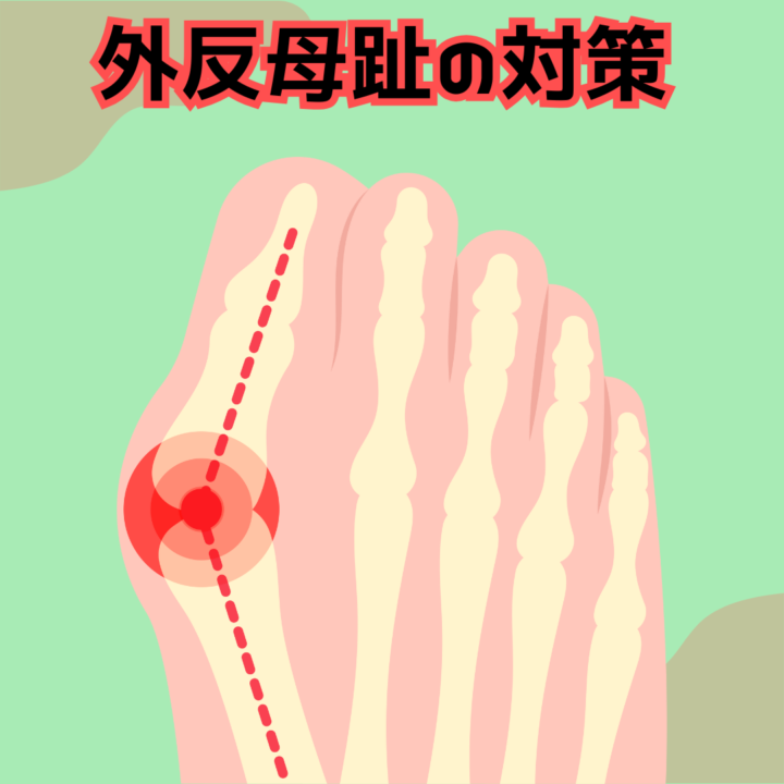 外反母趾の対策の画像