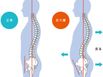 反り腰の背骨と骨盤