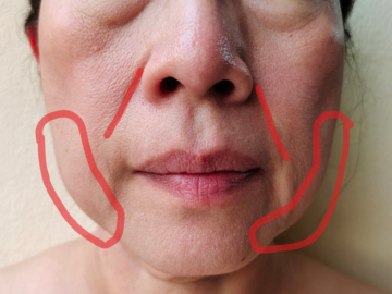 ほうれい線とえら